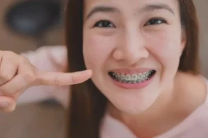 Manfaat Behel Gigi, Memperbaiki Susunan Gigi & Menambah Percaya Diri